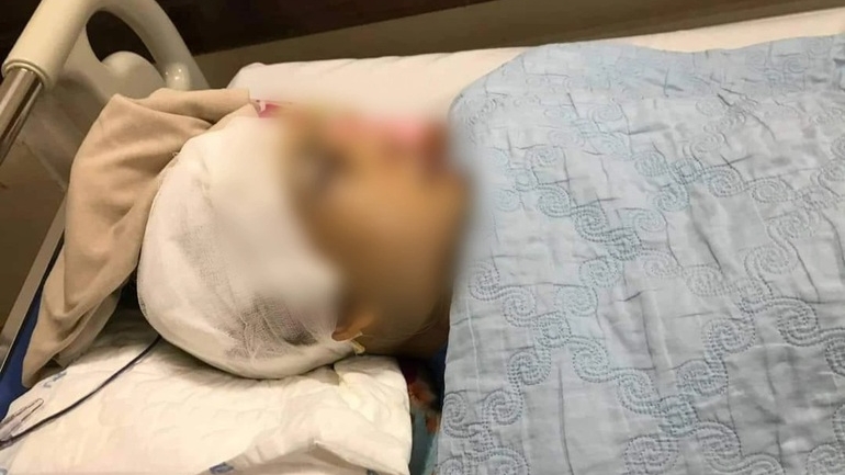 Một Phó Chủ tịch xã ở Hải Dương bị đánh vỡ hộp sọ khi thực thi công vụ