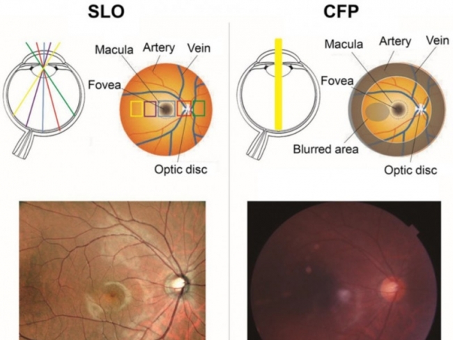 Nghiên cứu so sánh Công nghệ SLO và Chụp ảnh màu đáy mắt thông thường