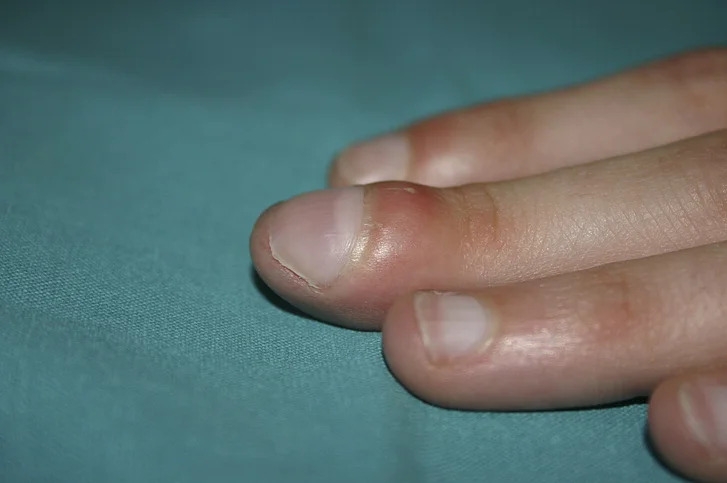 Triệu chứng ở ngón tay cảnh báo ung thư phổi